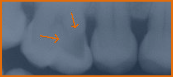 X-ray of several molars, with arrows pointing to darkened spot, which is a cavity